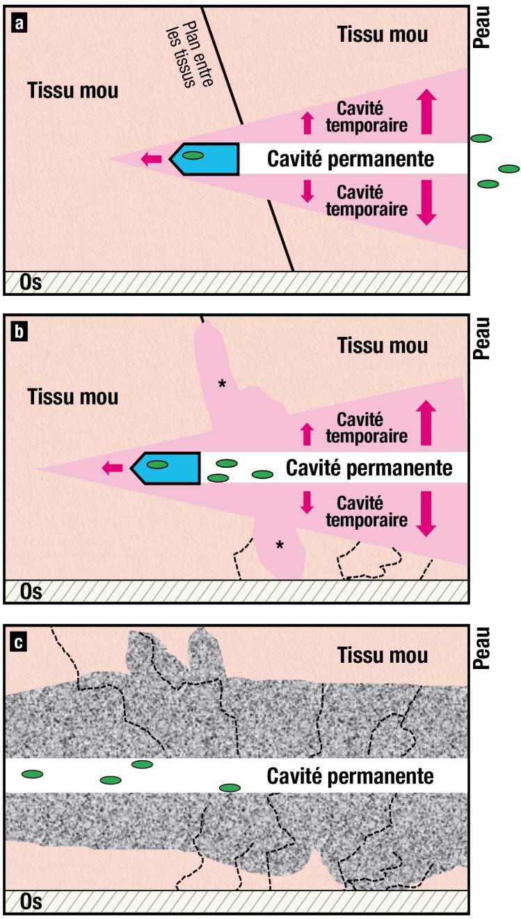 Un projectile pénètre l’organisme, transportant des bactéries et des débris