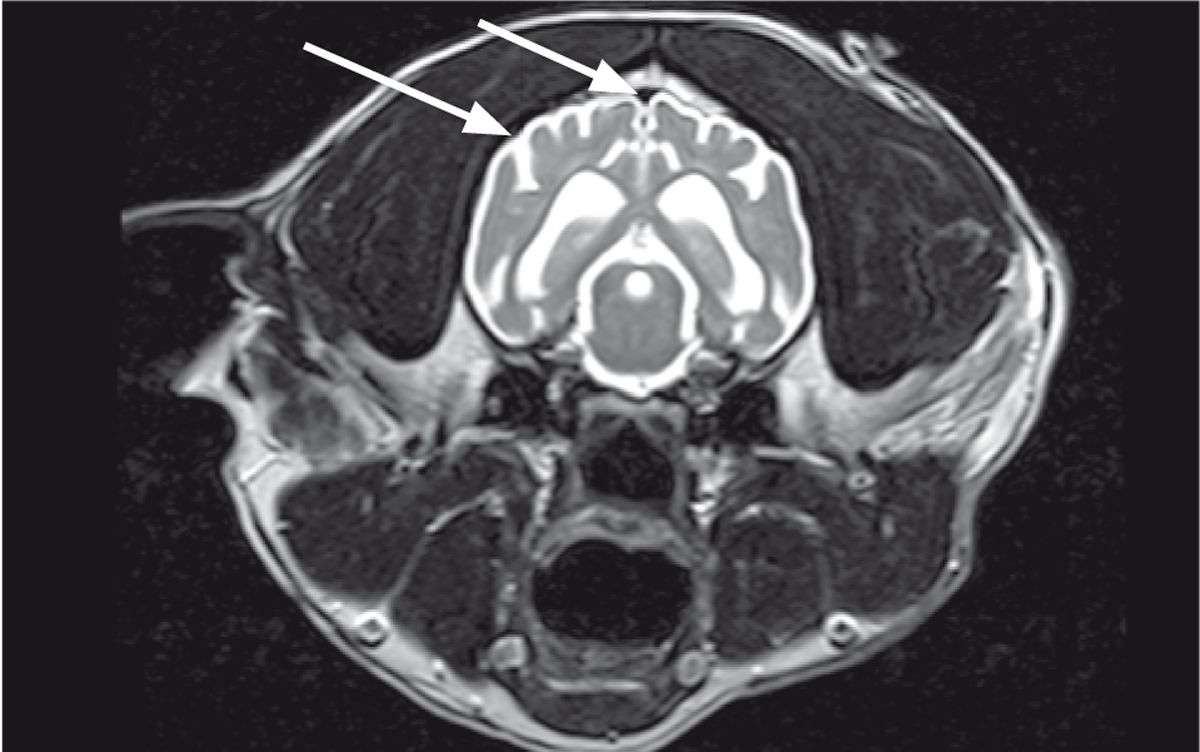 Figure 6. L’atrophie cérébrale est détectable à l’IRM. Cette image en coupe transversale pondérée en T2 montre un élargissement des sillons cérébraux et de l’espace sous-arachnoïdien secondaire à la perte de tissu cérébral (flèches).© William B. Thomas