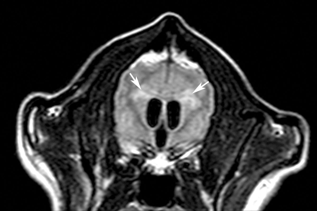 Figure 5. L’œdème périventriculaire associé à l’hydrocéphalie aiguë s’observe préférentiellement à l’IRM sur les séquences FLAIR en coupe transverse. On note l’hyperintensité de la substance blanche (flèches) adjacente aux ventricules latéraux et la forme arrondie des ventricules, indiquant une augmentation de la pression intraventriculaire.© William B. Thomas
