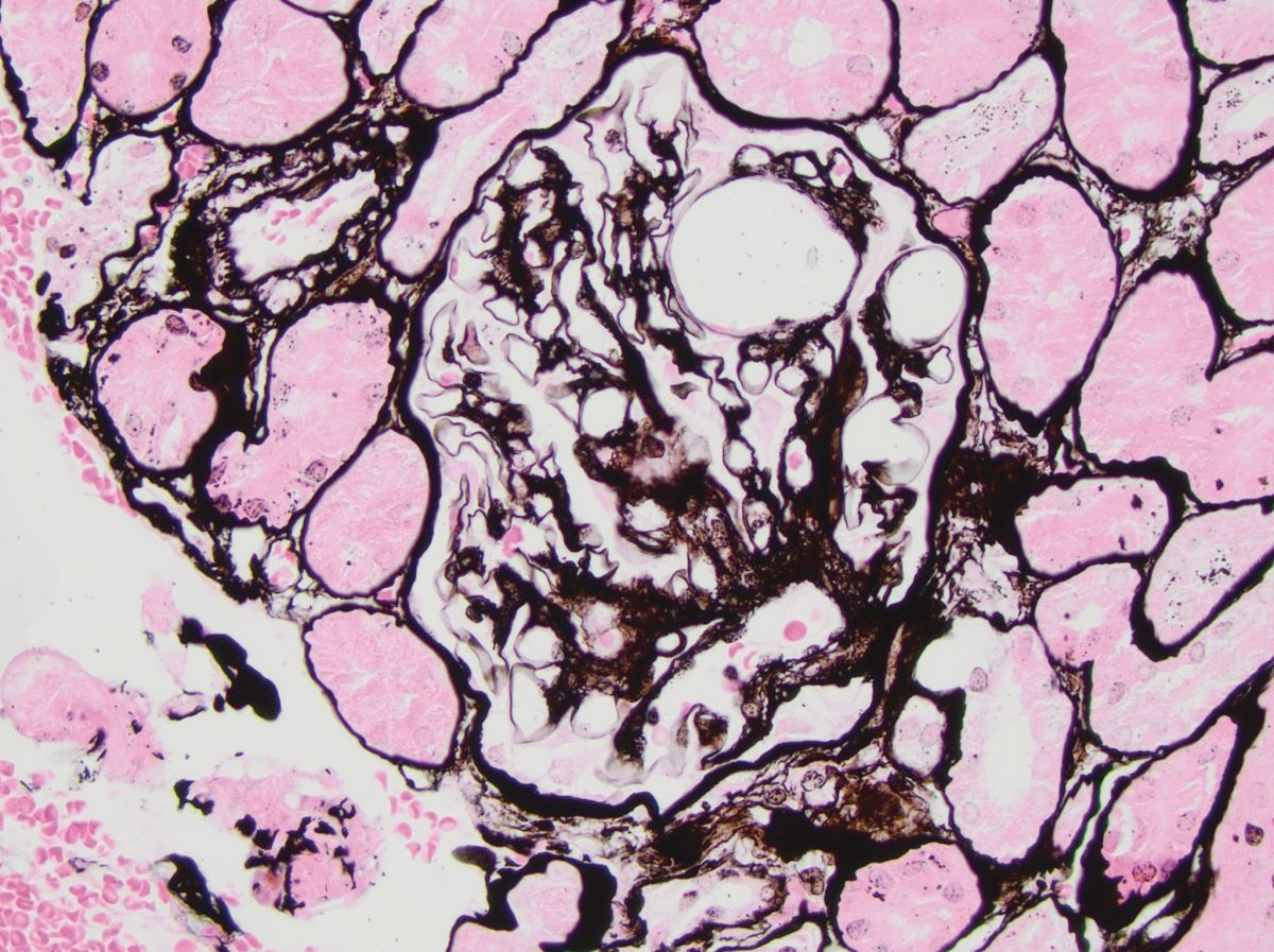 Thrombo-embolie lipidique glomérulaire chez un schnauzer nain mâle castré de 10 ans, avec hypertriglycéridémie primaire et protéinurie subclinique. Les thrombo-emboles lipidiques apparaissent comme des structures circulaires intracapillaires non colorées : méthamine d’argent de Jones. L’image a été prise au grossissement x 40.