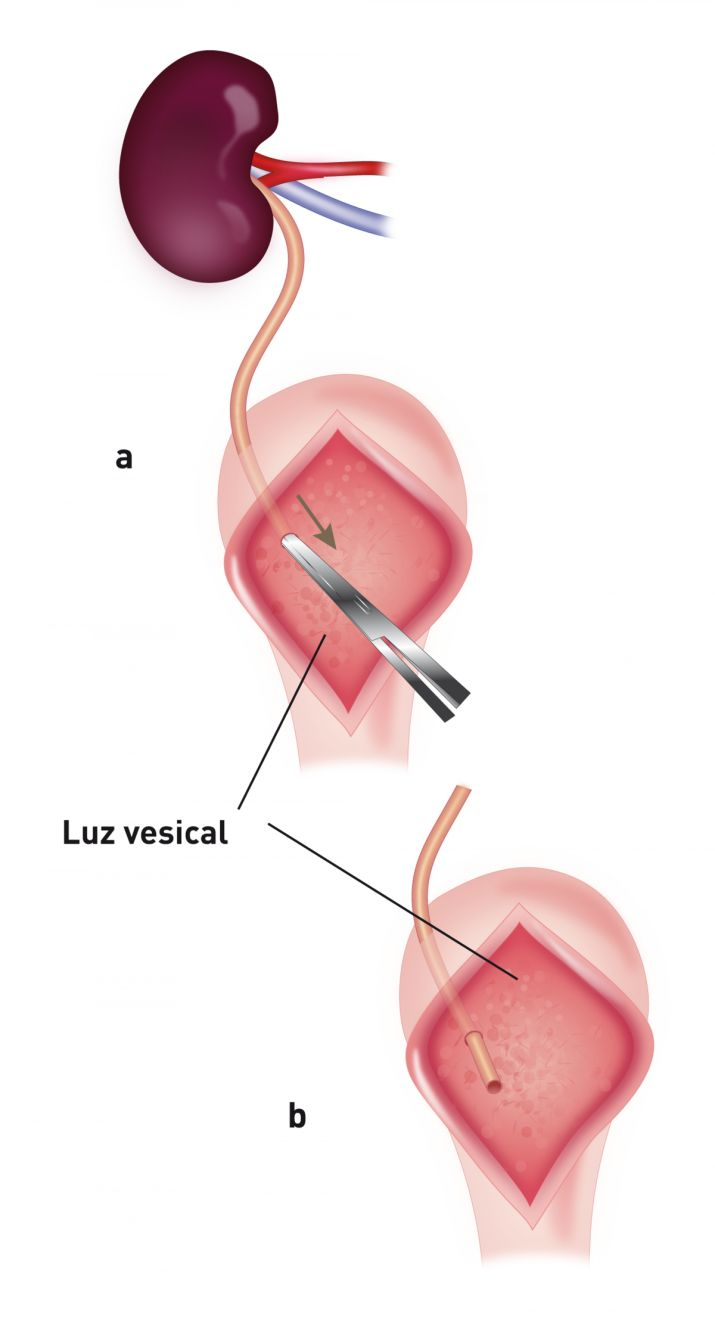 Ilustración que muestra la realización de una ureteroneocistostomía mediante la técnica intravesical de aposición de la mucosa. Se realiza una cistostomía en la línea media ventral y el uréter del donante se coloca directamente en la vejiga, a nivel del ápex (a, b).