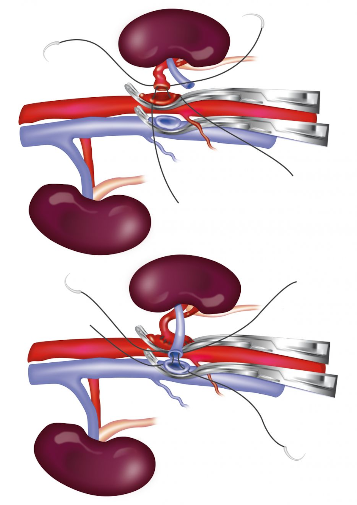 Schematische Darstellung einer End-zu-Seit-Anastomose des renalen Allotransplantates an die abdominale Aorta und die Vena cava des Empfängers. Die Nierenarterie (Bild oben) wird mittels End-zu-Seit-Anastomose mit 8-0 Nylon mit der Aorta verbunden, und die Nierenvene (Bild unten) wird mittels End-zu-Seit-Anastomose mit 7-0 Seide mit der V. cava verbunden.
