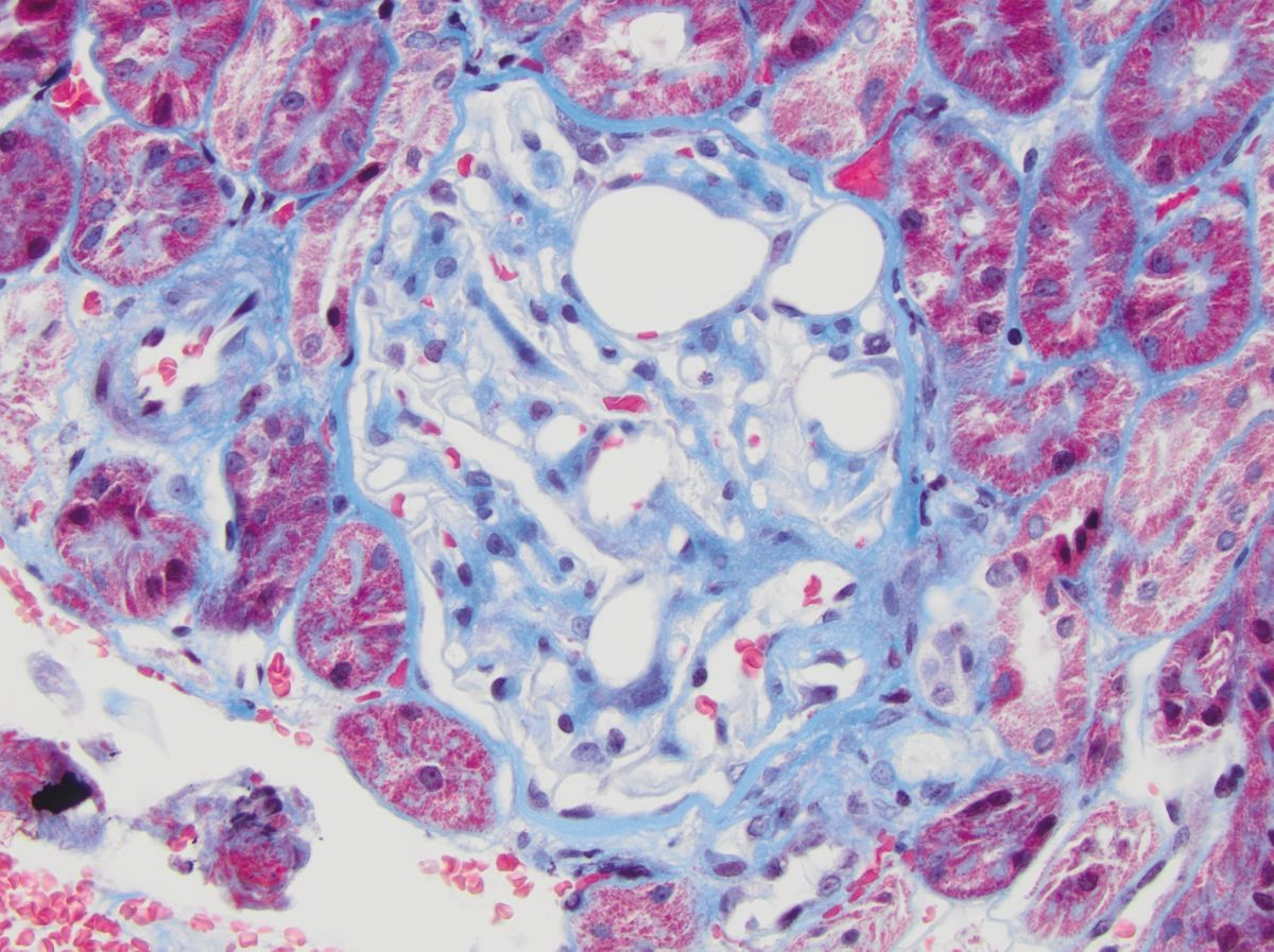 Tromboêmbolos lipídicos glomerulares em macho castrado da raça Schnauzer Miniatura de 10 anos de idade, com hipertrigliceridemia primária e proteinúria subclínica. Os tromboêmbolos lipídicos são visualizados como estruturas circulares intracapilares que não se coram; tricrômio de Masson. As imagens foram obtidas em aumento de 40×. 