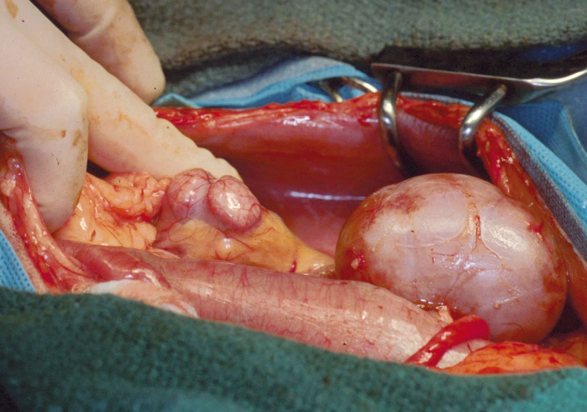 Diese intraoperative Aufnahme zeigt die native Niere (links) und das Allotransplantat (rechts). Die native Niere des Empfängers wird in der Regel an Ort und Stelle gelassen, um im Falle einer verzögerten Transplantatfunktion als Reserve zu dienen.