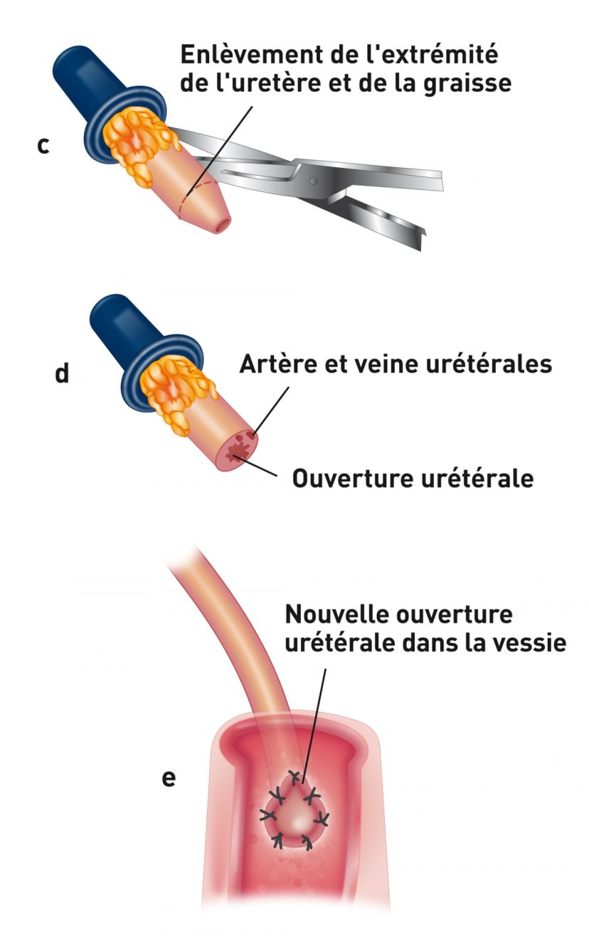 Schéma montrant l'urétéronéocystostomie en utilisant une technique d'apposition de la muqueuse intravésiculaire. L'extrémité de l'uretère qui avait été traumatisée après avoir été tirée dans la vessie est ensuite réséquée jusqu’au tissu sain et la graisse péri-urétérale est ôtée de l'extrémité de l'uretère pour faciliter la suture (c). Après l'amputation, l'ouverture de l'uretère est visualisée. Il est rare que l'artère urétérale doive être ligaturée (d). L'extrémité de l'uretère est ensuite spatulée ; il s'agit de placer des ciseaux microvasculaires dans la lumière de l'uretère et de faire une petite incision (5 mm) pour l'ouvrir. La muqueuse urétérale est ensuite suturée à la muqueuse de la vessie avec des points simples et interrompus (e).