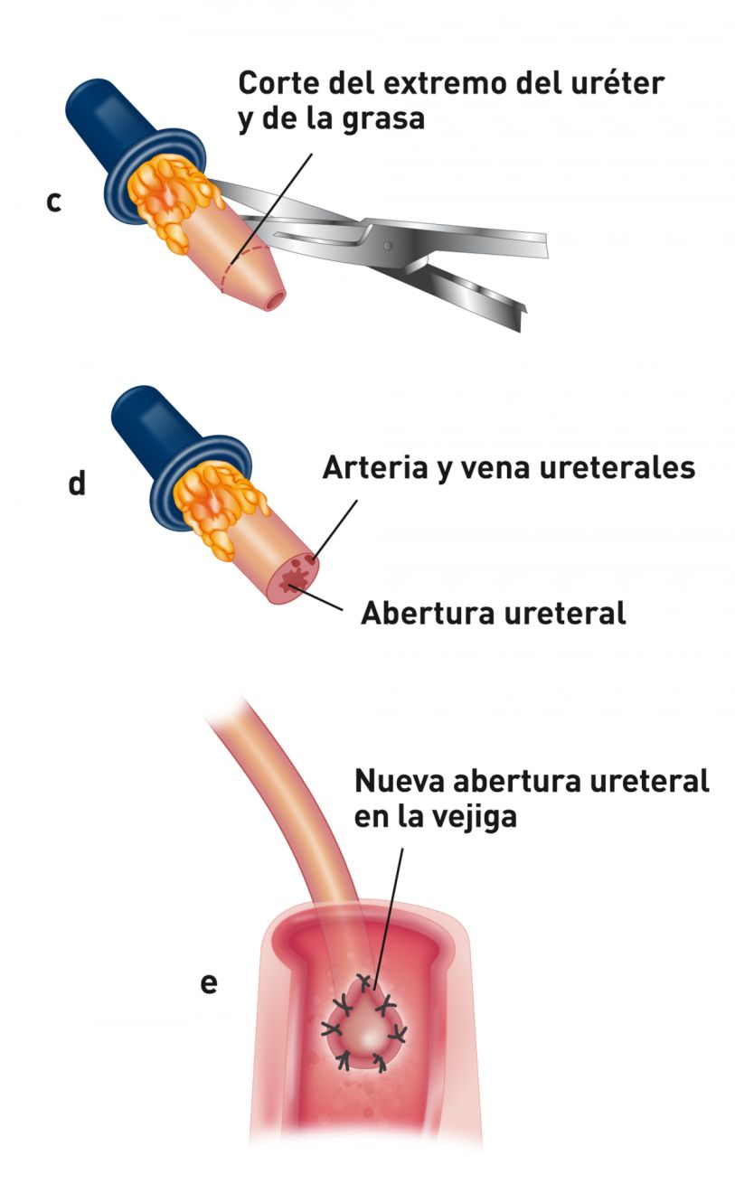 Ilustración que muestra la realización de una ureteroneocistostomía mediante la técnica intravesical de aposición de la mucosa. El extremo del uréter que se ha dañado al implantarlo en la vejiga se resecciona para volver a obtener tejido sano y se elimina la grasa periureteral del extremo del uréter para facilitar la posterior sutura (c). Después del corte del uréter, se puede visualizar la abertura ureteral. En raras ocasiones es necesario ligar la arteria ureteral (d). El extremo del uréter se espatula; lo que conlleva la realización de una pequeña incisión (5 mm) con tijeras microvasculares en la luz del uréter para mantenerlo abierto. Después se sutura la mucosa ureteral a la vejiga mediante sutura discontinua simple (e).