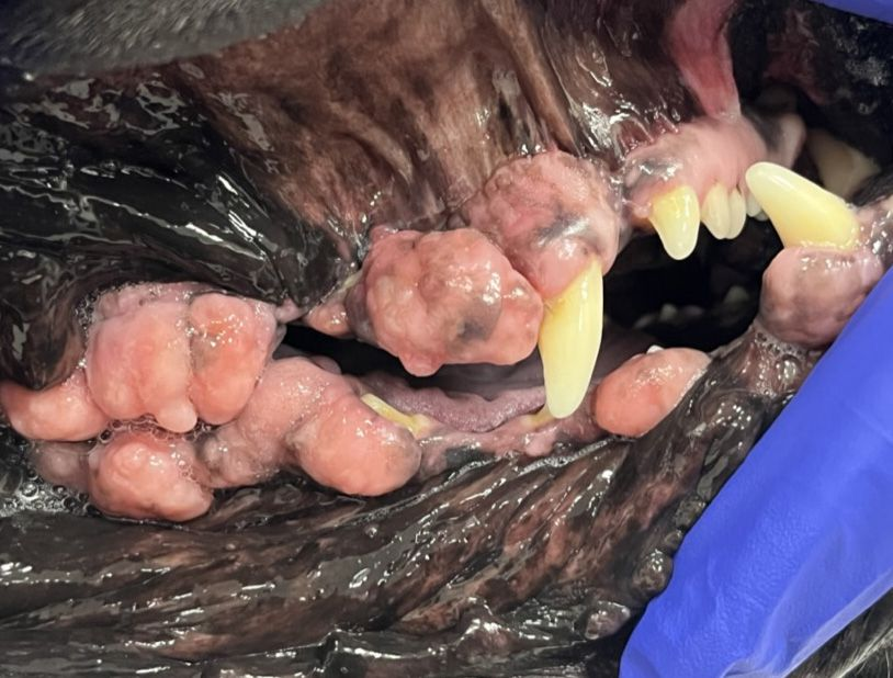 hyperplasie gingivale b