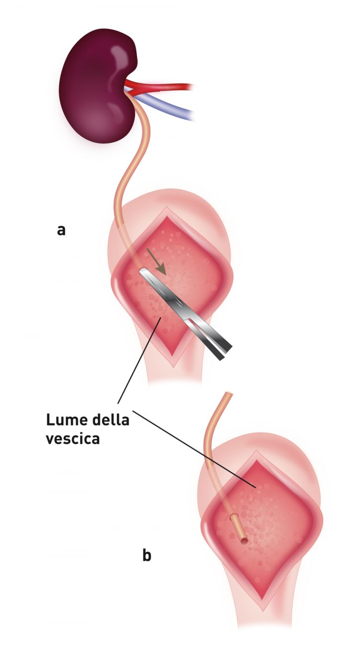 L’immagine mostra l'ureteroneocistostomia con tecnica di apposizione mucosale intravescicale. Si esegue una cistotomia sulla linea mediana ventrale e si porta l'uretere del donatore direttamente nella vescica a livello dell'apice (a, b).