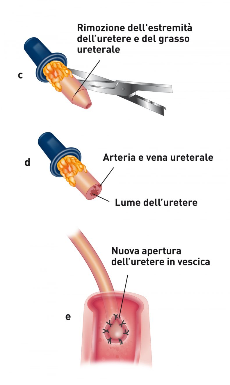L’immagine mostra l'ureteroneocistostomia con tecnica di apposizione mucosale intravescicale. L'estremità dell'uretere viene resecata fino al tessuto sano ed il grasso periureterale rimosso dall'estremità dell'uretere per facilitarne la sutura (c). Diventa così visibile l'apertura dell’uretere. Non di rado, può essere necessario ligare l'arteria ureterale (d). L'estremità dell'uretere viene quindi spatolata: si inseriscono forbici microvascolari nel lume dell'uretere e si realizza una piccola incisione (5 mm) per svasarlo. La mucosa ureterale viene quindi suturata alla mucosa vescicale con sutura a punti semplici staccati (e).
