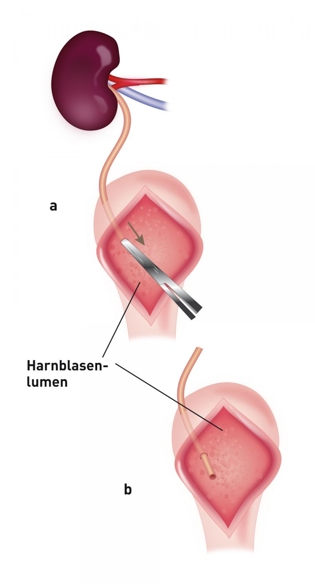 Schematische Darstellung einer Ureteroneozystostomie mittels intravesikulärer Schleimhautappositionstechnik. Nach Zystotomie in der ventralen Mittellinie wird das Ende des Spenderharnleiters an der Apex direkt in die Blase eingebracht (a, b).