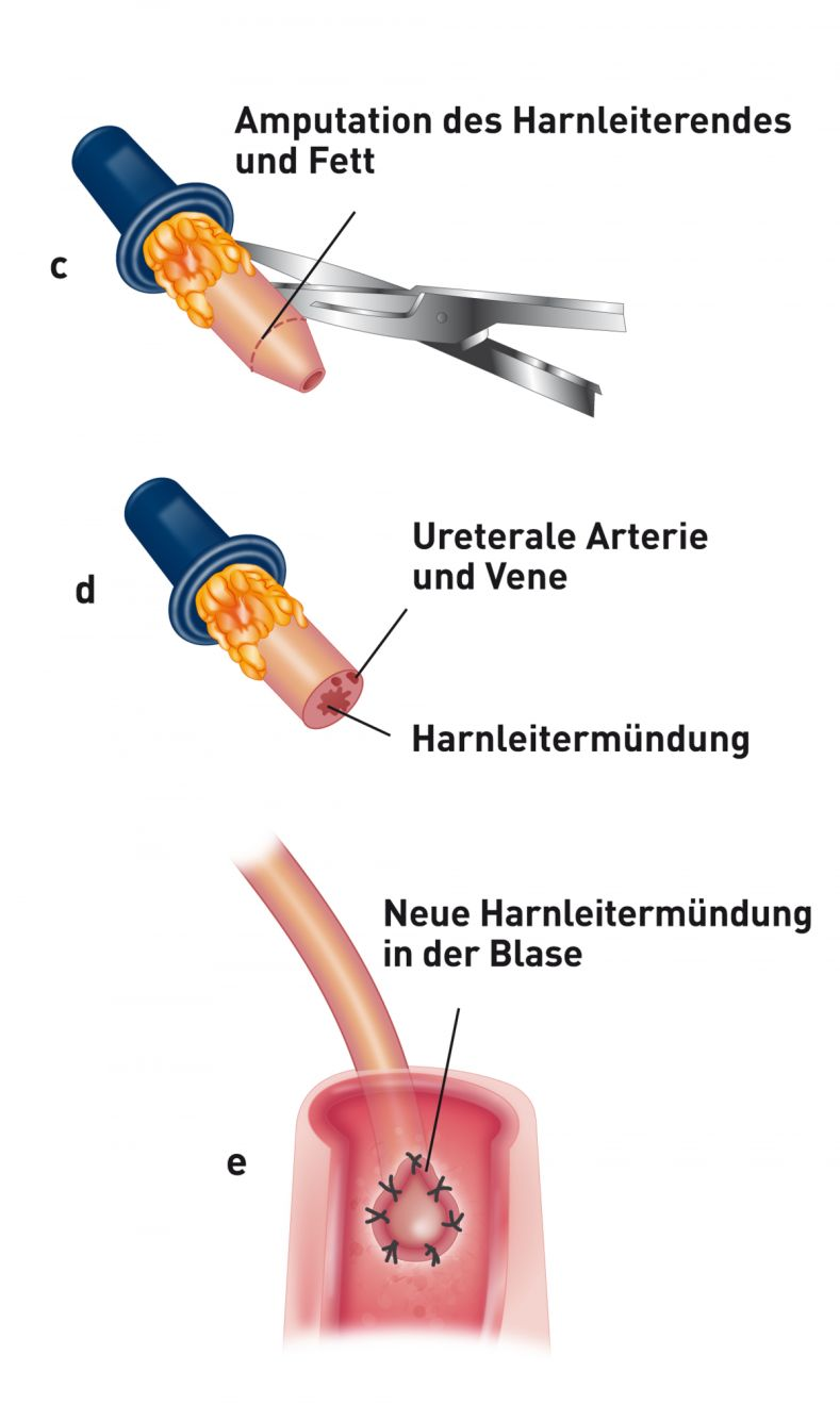 Schematische Darstellung einer Ureteroneozystostomie mittels intravesikulärer Schleimhautappositionstechnik. Das durch das Hineinziehen in die Blase traumatisierte Ende wird bis zum gesunden Gewebe reseziert, und periureterales Fett wird vom Ende des Harnleiters entfernt, um die Naht zu erleichtern (c). Nach der Amputation wird die Harnleitermündung dargestellt. Selten muss die Harnleiterarterie ligiert werden (d). Das Ende des Harnleiters wird anschließend spatuliert (eingekerbt): eine Mirkogefäßschere wird in das Lumen des Harnleiters eingeführt, um die Harnleiterwand auf 5 mm zu spatulieren. Die Harnleiterschleimhaut wird nun mit einfachen Einzelheften mit der Blasenschleimhaut vernäht (e).