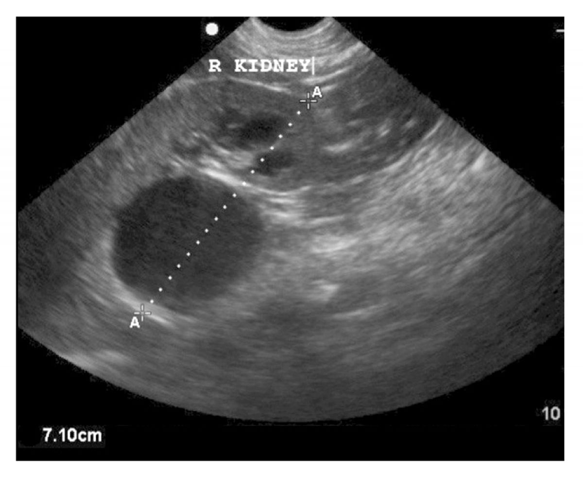 Renal cortical cysts are anechoic and intraparenchymal, and typically do not distort the renal capsule.