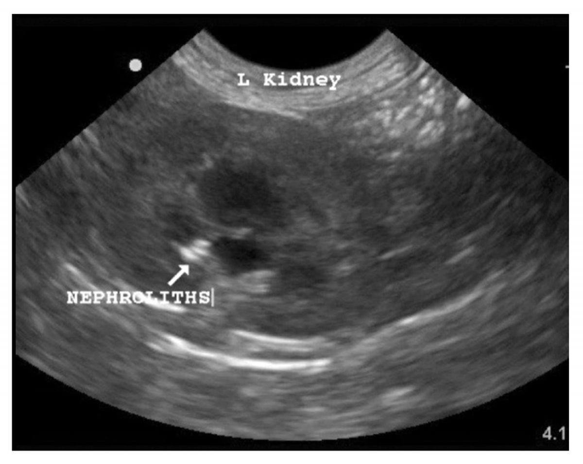 Os nefrólitos dentro do rim podem ou não ser facilmente identificados por meio da ultrassonografia.