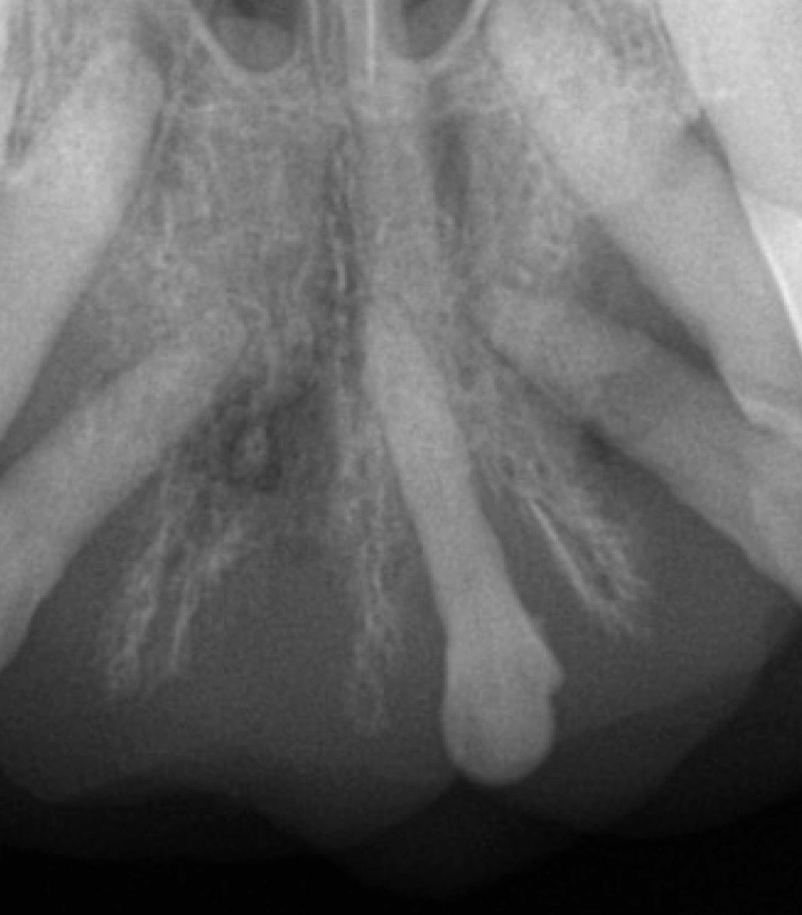 Figure 4. Ostomylite. Limage (a) montre une hyperplasie gnralise de la gencive et de la muqueuse palati