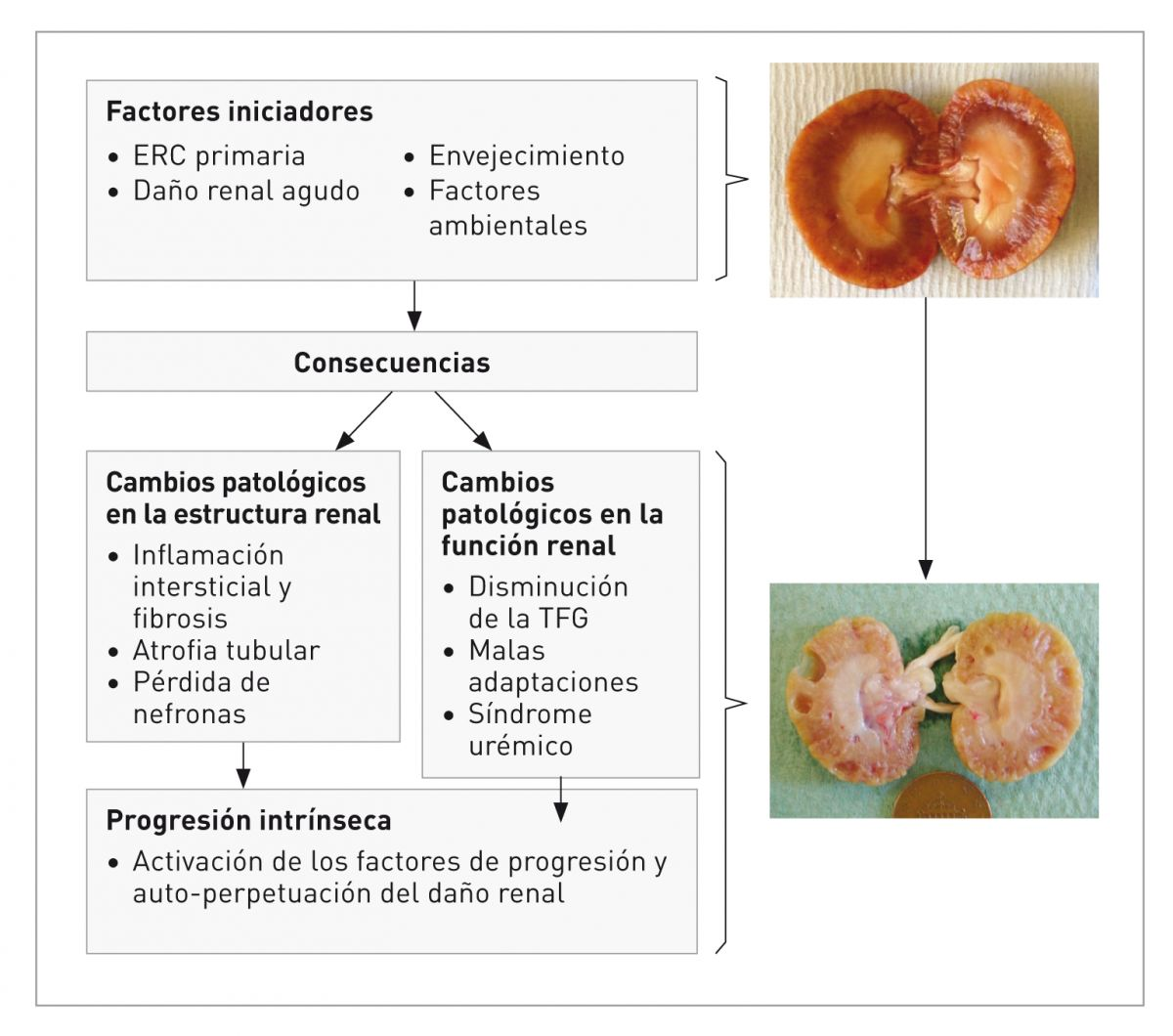Mecanismo propuesto generalmente aceptado, sobre el inicio y la progresión de la enfermedad renal crónica. Los factores iniciadores llevan a las “consecuencias”: cambios en la estructura y en la función renal. A medida que la enfermedad renal progresa y se produce una pérdida de nefronas significativa, las respuestas maladaptivas intrínsecas al gato siguen contribuyendo al daño renal y a la pérdida de nefronas. Las imágenes del riñón diseccionado muestran un riñón sano (arriba) y un riñón con ERC en estadio terminal (abajo). 
