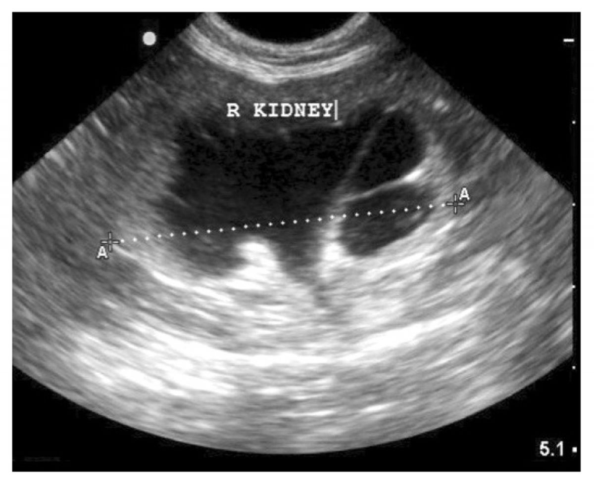 Hydronephrosis is defined as severe pyelectasia with blunting of the renal papilla.