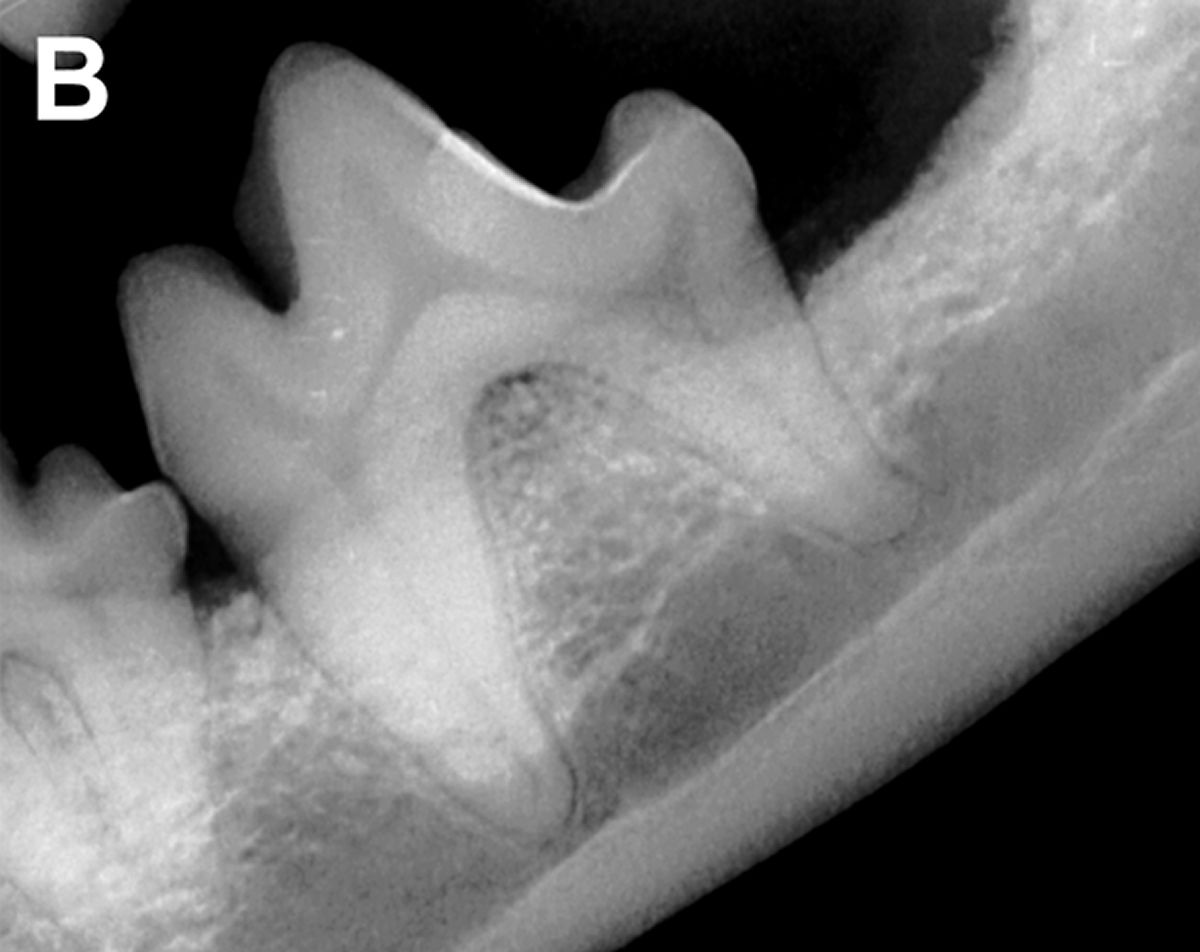 An intraoral dental radiograph (same technique) taken at the three-month postoperative recheck of the patient; the degree of periodontitis has improved from 50% bone loss to ~20-30% bone loss and the left mandibular second molar tooth extraction site has remodeled. 
