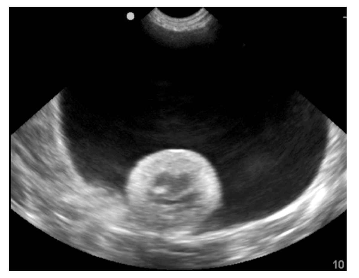 Perinephric pseudocysts are fluid-filled fibrous sacs that surround the kidney; in cats they are idiopathic in nature but usually occur in association with CKD.