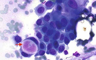 urothelial carcinoma