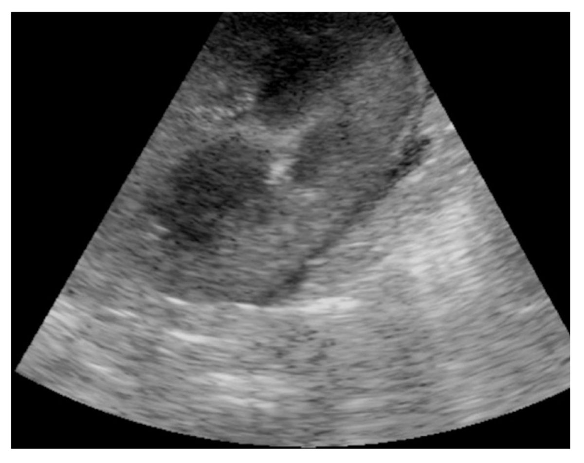 Perirenal fluid is visualized as fluid within the renal capsule; if found further investigation is warranted, as rule-outs include acute kidney injury.