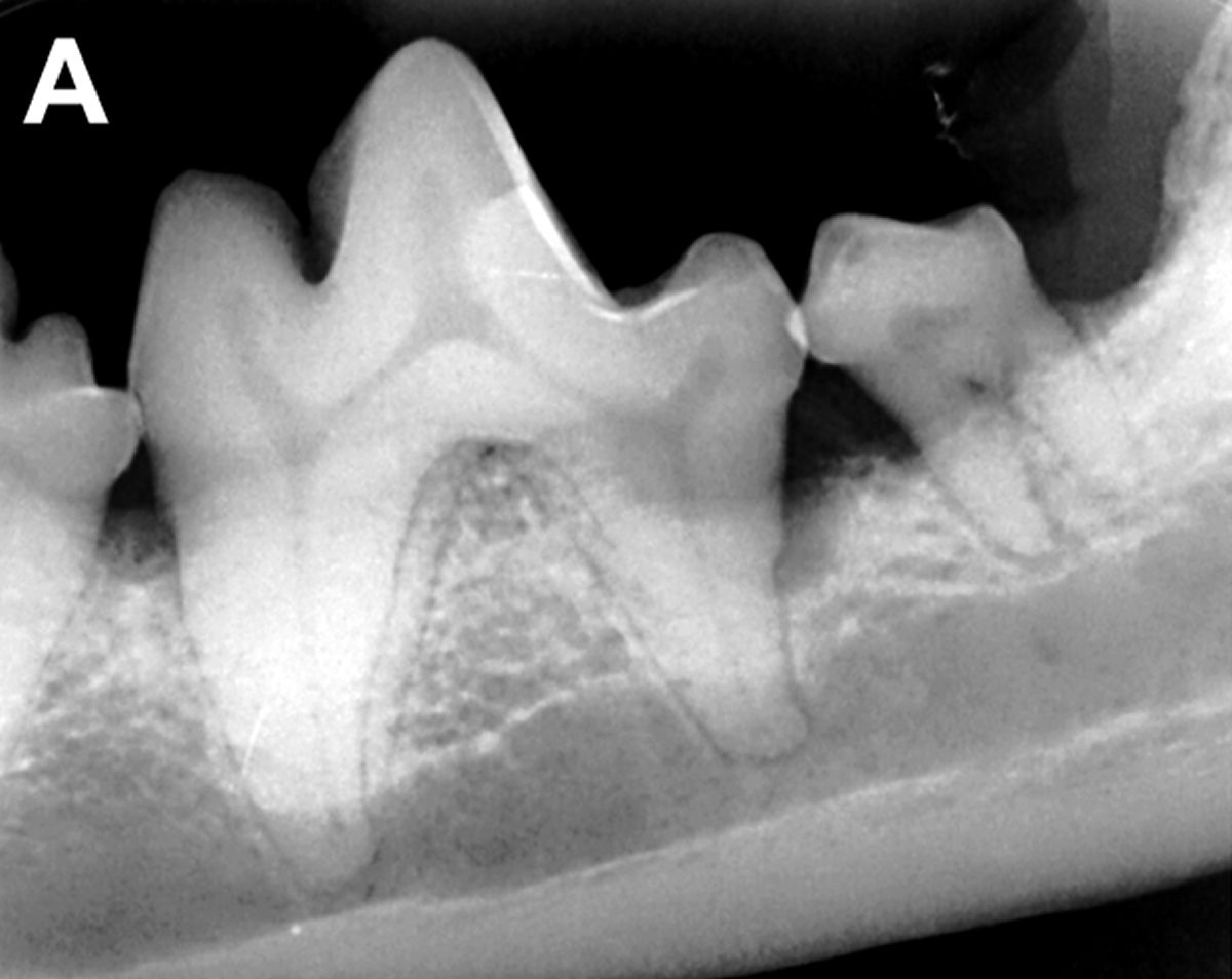 Diese intraorale Zahnröntgenaufnahme (Aufnahme der linken Unterkiefermolaren, Rechtwinkel/Paralleltechnik) eines Norwich Terriers zeigt eine hochgradige Parodontitis an der distalen Wurzel des linken mandibulären M1 (20 % horizontaler Knochenverlust plus 30 % vertikaler Knochenverlust). Die Behandlung umfasste die Extraktion des linken mandibulären M2 und eine gesteuerte Geweberegeneration der distalen Wurzel des linken mandibulären M1. 
