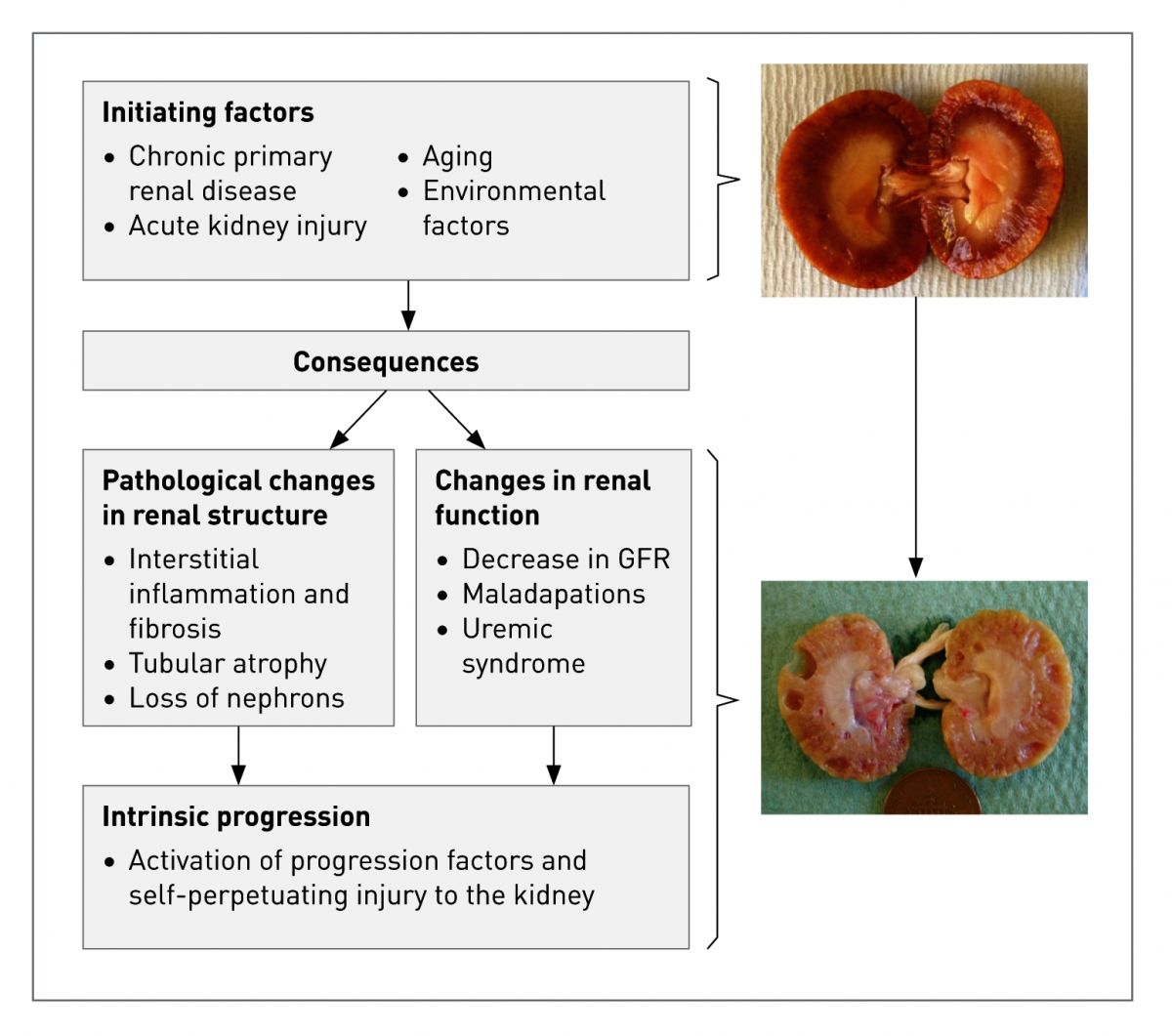 The generally accepted proposed mechanism for initiation and progression of chronic kidney disease. Initiating factors lead to the “consequences”: changes in renal structure and function. As the disease progresses and significant nephron loss occurs, maladaptive responses intrinsic to the cat further contribute to renal damage and nephron loss. Images of the dissected kidney illustrate a healthy kidney (above) and end stage CKD kidney (below).
