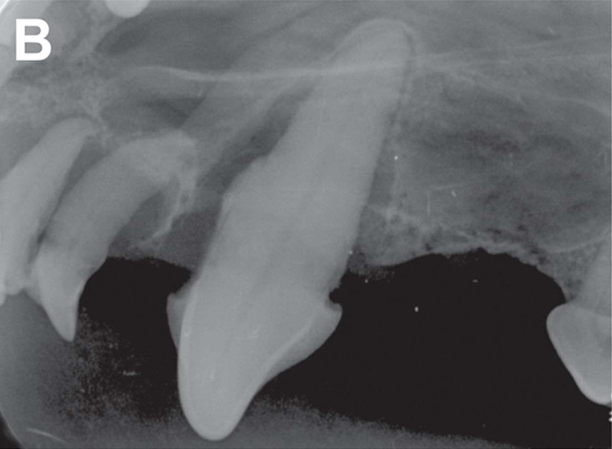 The intraoral dental radiograph (left lateral canine view, bisecting angle technique) reveals 80% vertical bone loss of the left maxillary canine tooth, consistent with oronasal fistula. The radiograph also reveals near total loss of attachment of the left maxillary second incisor tooth with mild dilaceration of the root and 80% horizontal bone loss of the left maxillary third incisor tooth, which is microdont. The left maxillary first and second premolar teeth are missing. There is exuberant calculus accumulation on the crown of the left maxillary canine tooth, which is noted to have an abnormally straight root conformation. 