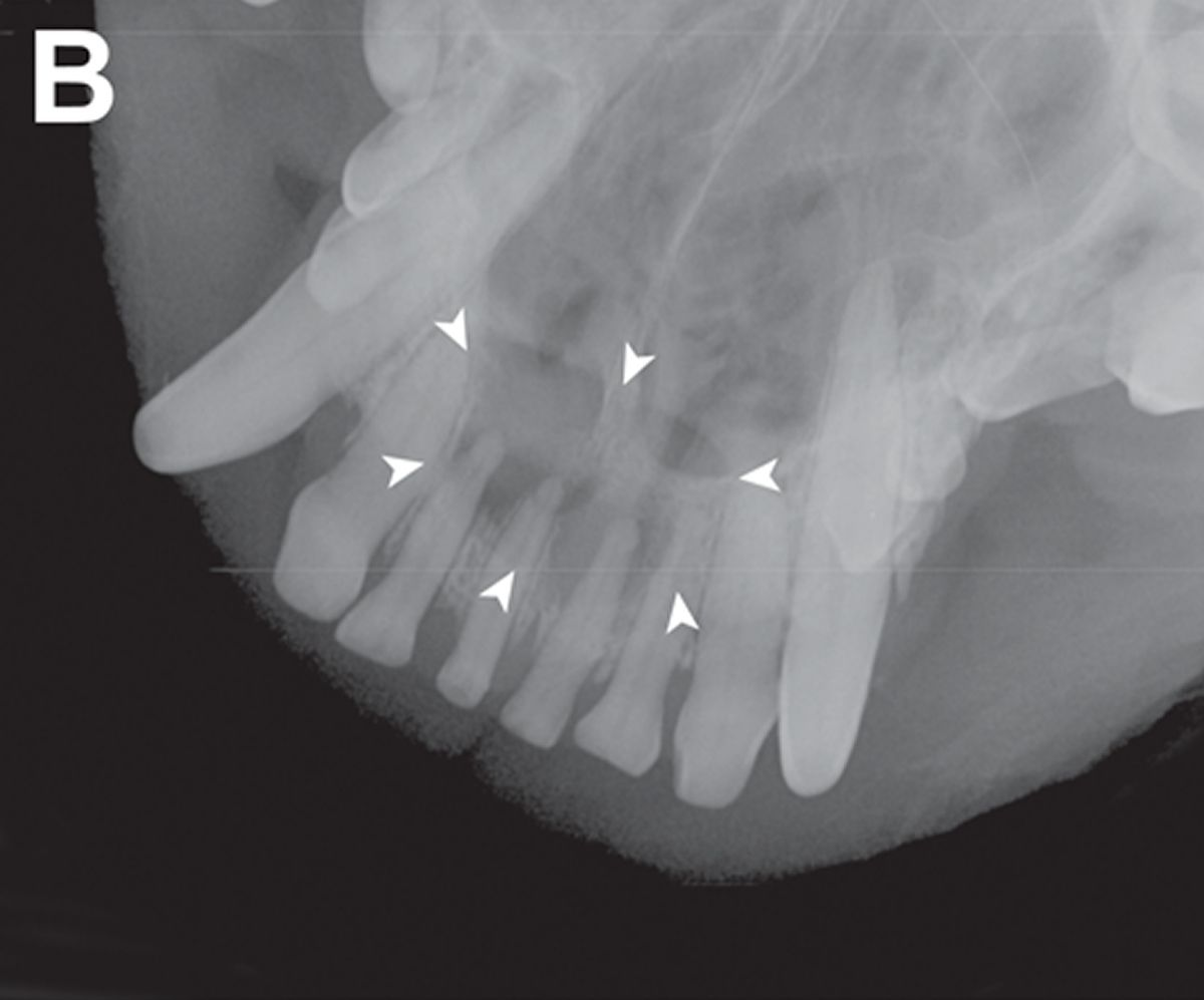 Radiographie dentaire intra-orale (vue en occlusion maxillaire, technique de l’angle bissecteur) confirmant l’abrasion de la canine et de l’incisive maxillaires et montrant une zone transparente bien nette de coalescence périapicale (flèches) autour des 1re et 2e incisives à droite et à gauche. 