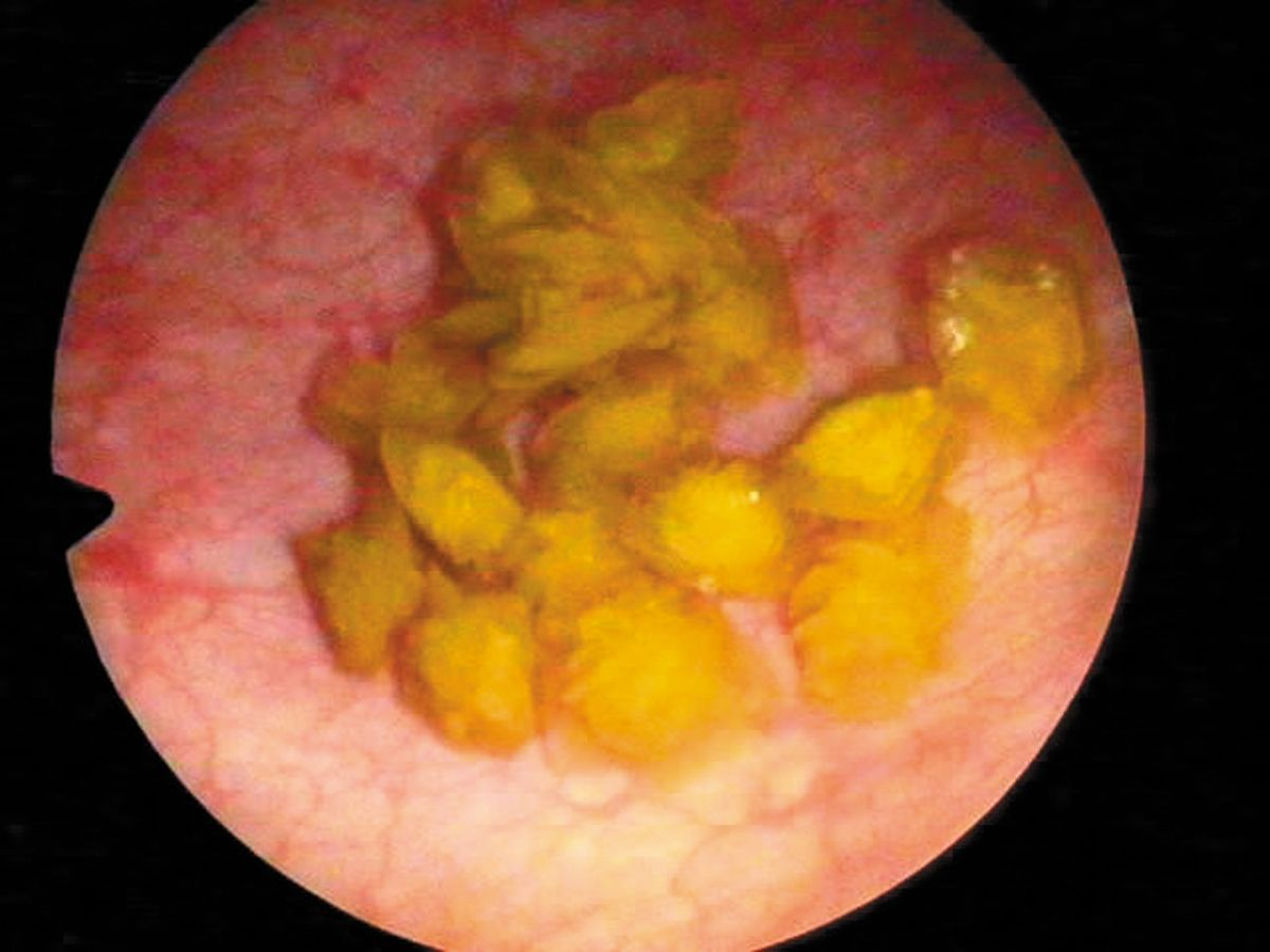 Zystoskopische Entfernung von Harnsteinen via Fangkorb über eine retrograde Zystoskopie. Zahlreiche unregelmäßig geformte Steine sind in der Blase zu erkennen.