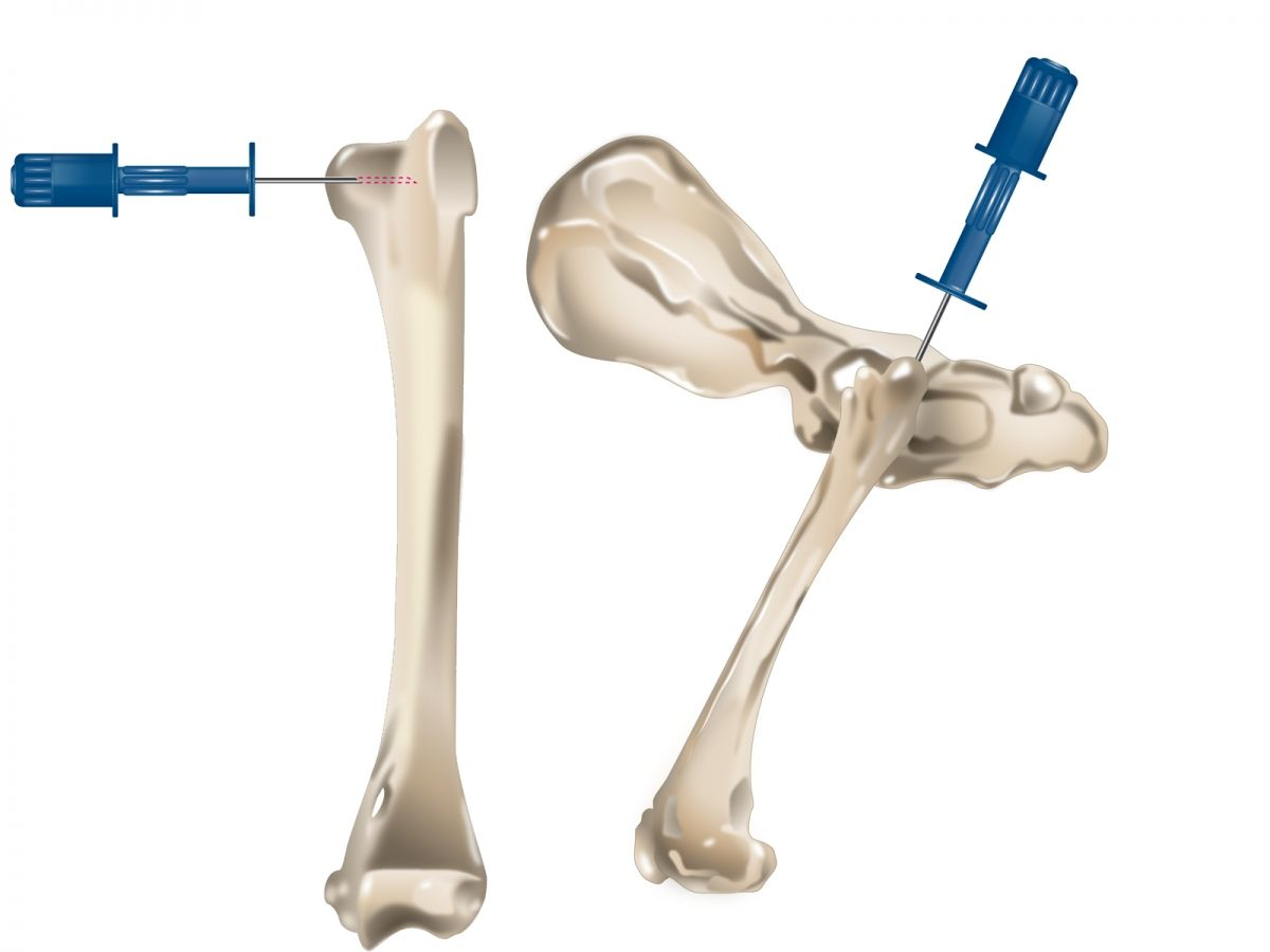 Un cathéter intra-osseux peut être placé dans l’humérus ou le fémur proximal des patients chez qui l’accès veineux pose problème, comme cela est montré ici.