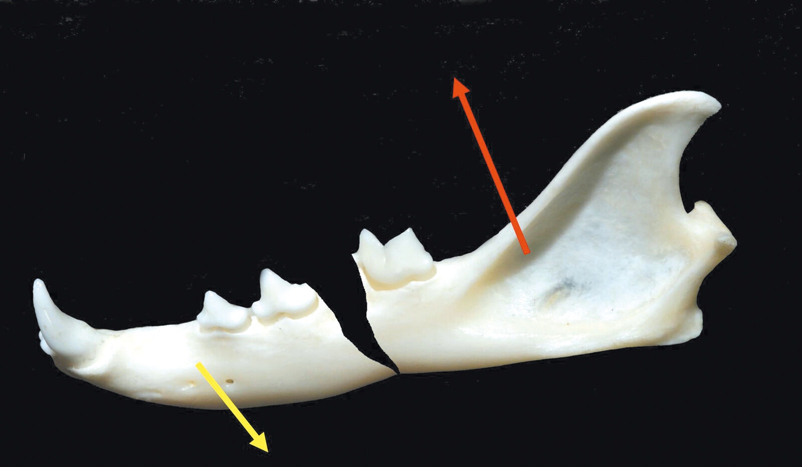 Figura 3. Fractura del cuerpo mandibular; la flecha amarilla muestra la dirección en la que tiran los músculos que abren la mandíbula; la flecha roja muestra la dirección en la que tiran los músculos que cierran la mandíbula. Apertura de la línea de fractura y mal alineamiento 