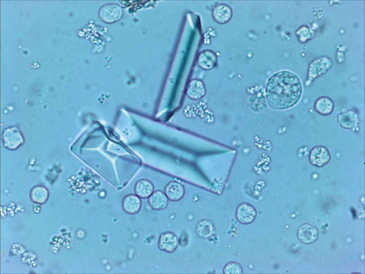 Refrigeration of a urine sample can cause precipitation of struvite crystals.