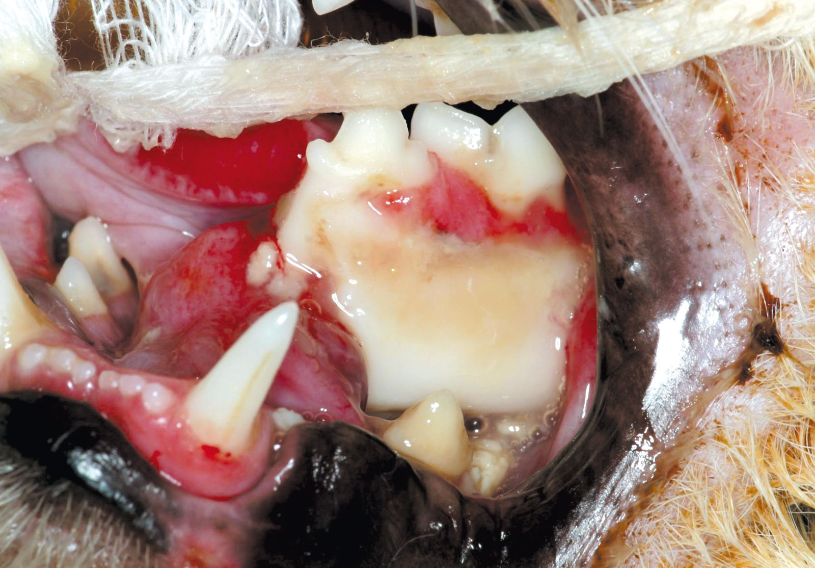 Figure 4. Fracture de la mandibule avec dplacement :a