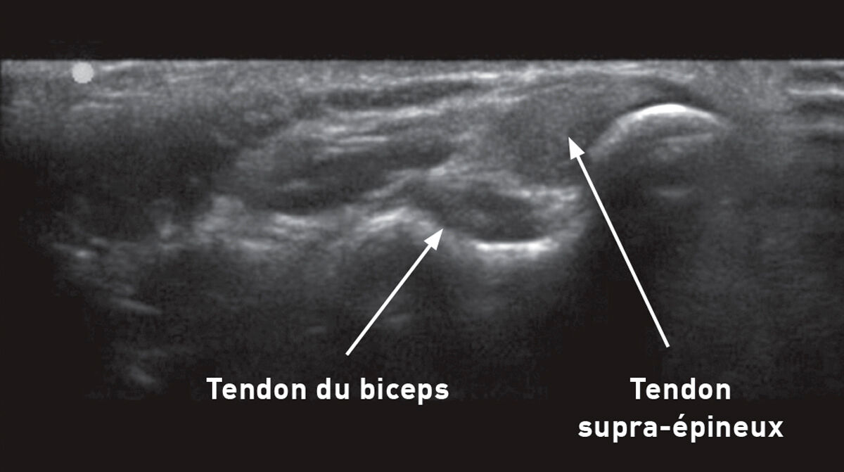 Un bilan complet peut faciliter la détection précoce de blessures chez les chiens de travail, comme cette échographie du membre antérieur d’un chien, montrant l’aspect normal des tendons du biceps et du supra-épineux.