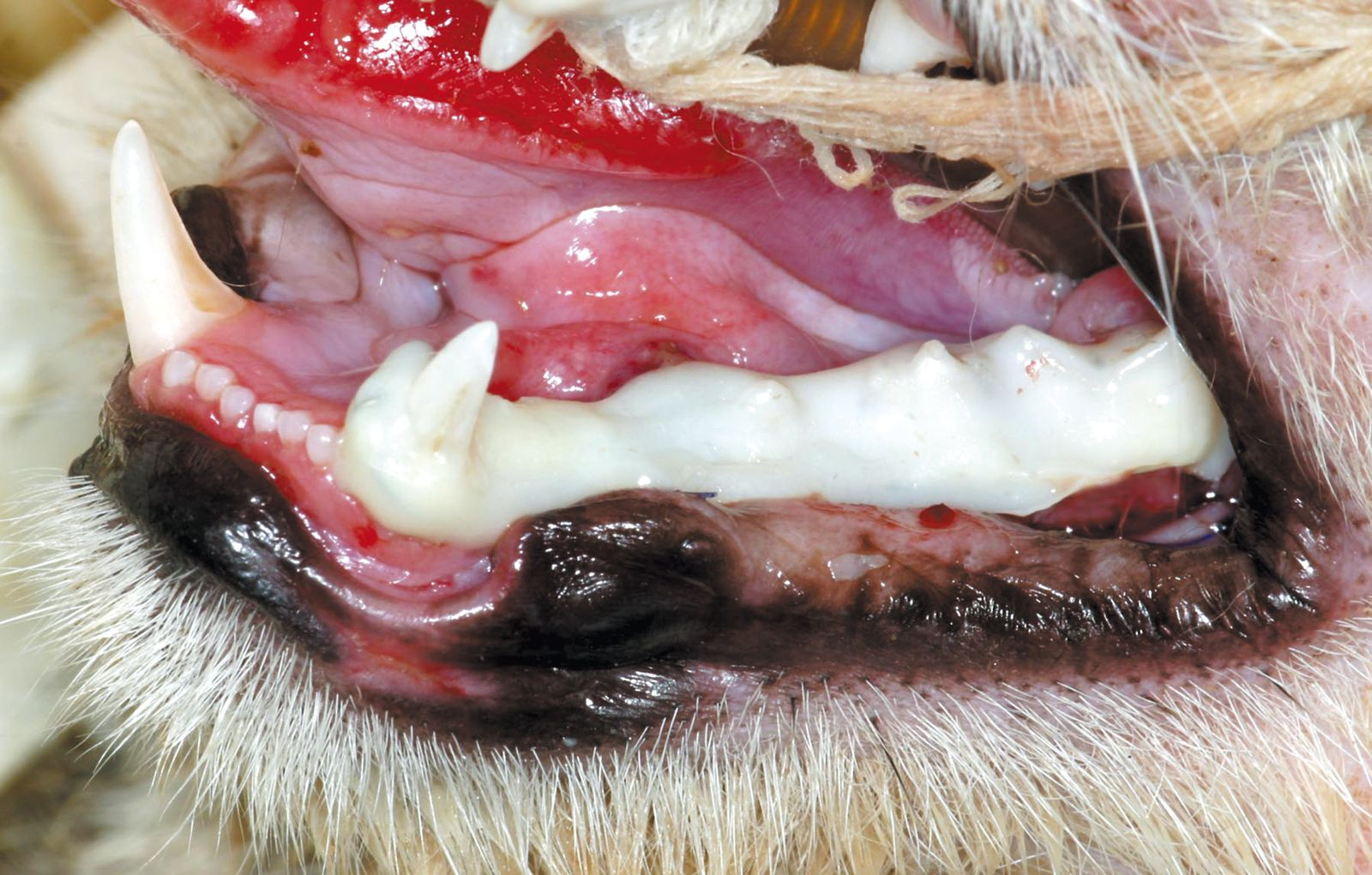 Figure 4. Fracture de la mandibule avec dplacement 