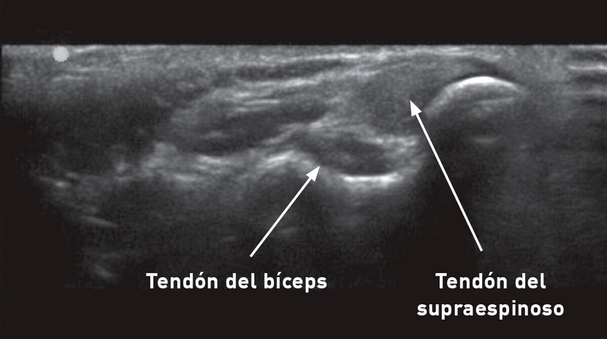 Una exploración detallada puede contribuir a la detección precoz de lesiones en animales de trabajo. Esta ecografía musculoesquelética de la extremidad anterior de un perro sirve como referencia al mostrar la apariencia normal de los tendones del bíceps y del supraespinoso. 