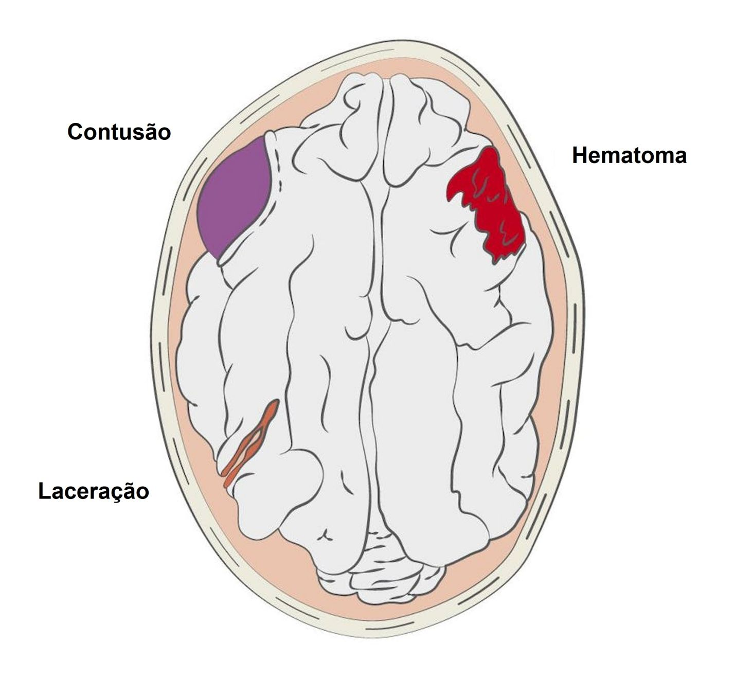Representação visual de determinadas lesões cerebrais primárias