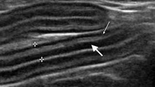 Chronic enteropathy in cats