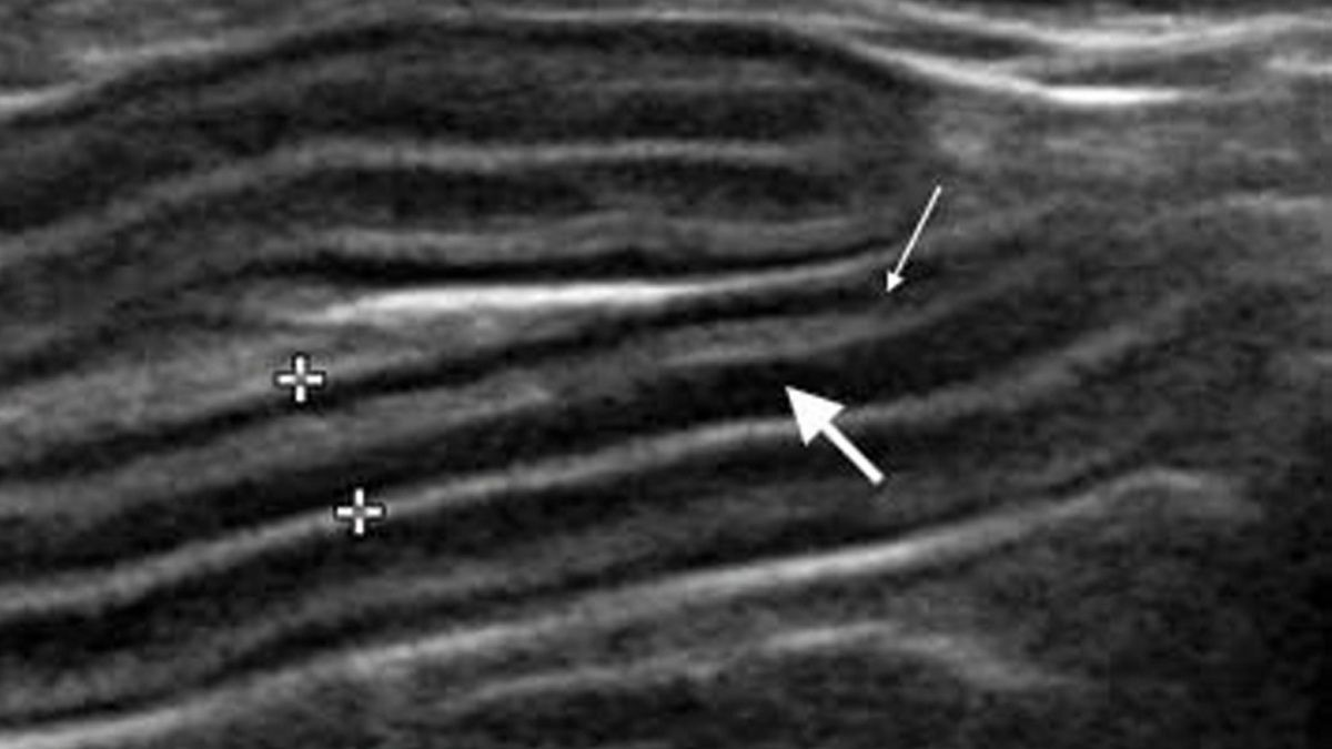 Хронічна ентеропатія у котів