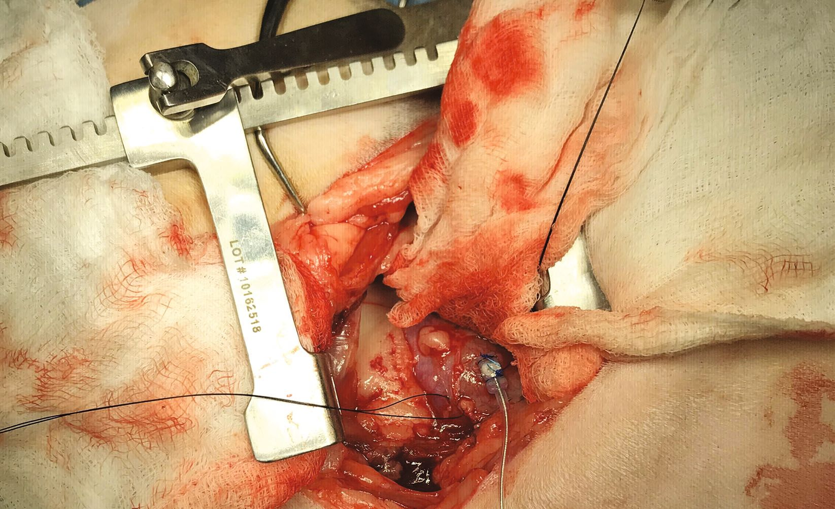 A permanent pacemaker was surgically implanted, with a lead sutured to the left ventricular epicardium