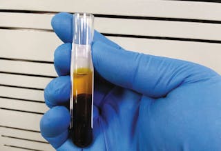 Evidence of hyperbilirubinemia in a blood sample