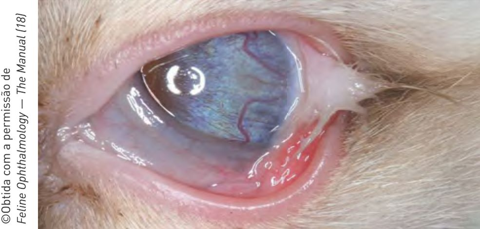 Figura 7. Dermoide conjuntival com tufo saliente de pelos,