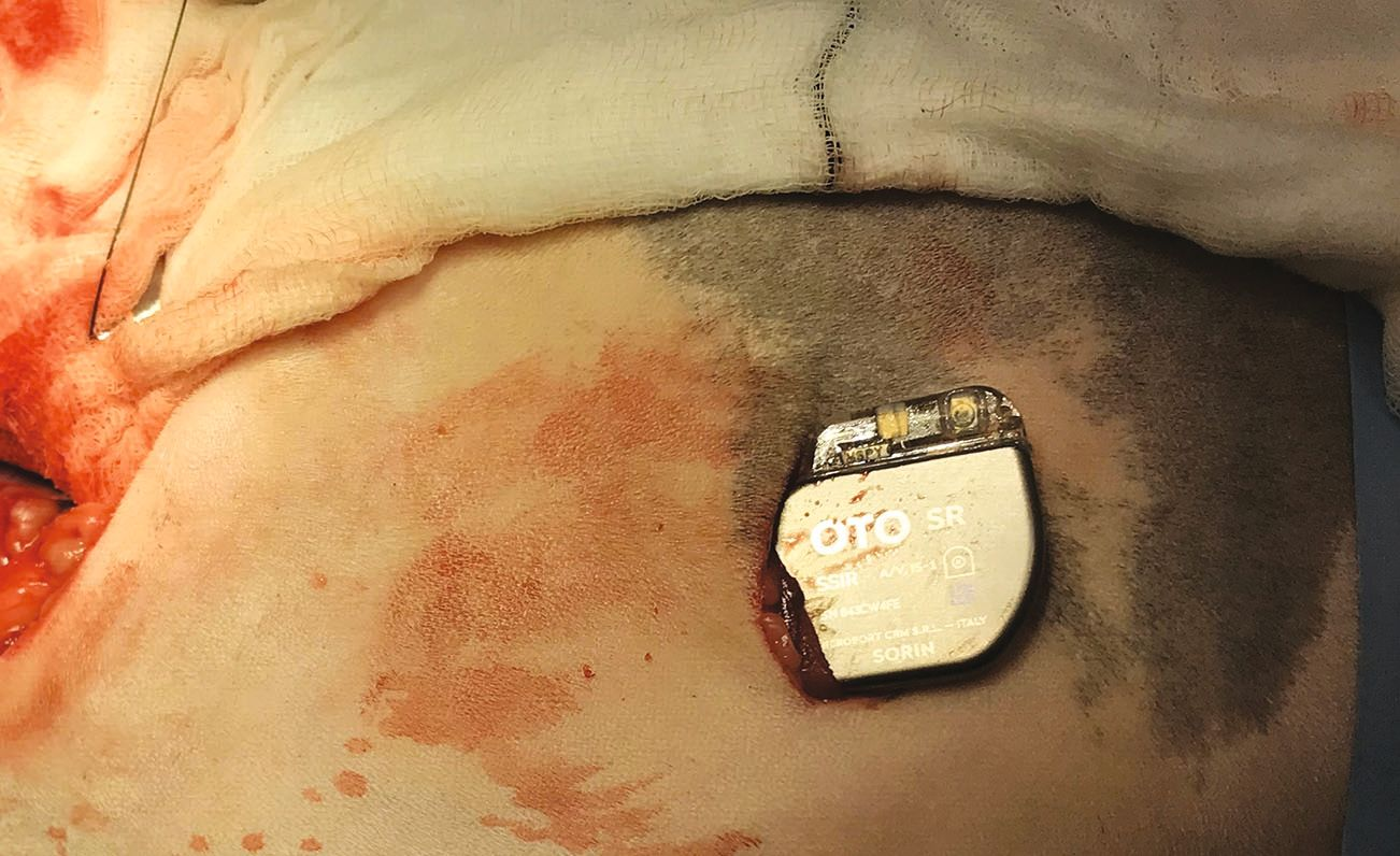 La sonde épicardique a été insérée sous les muscles de la paroi thoracique latérale