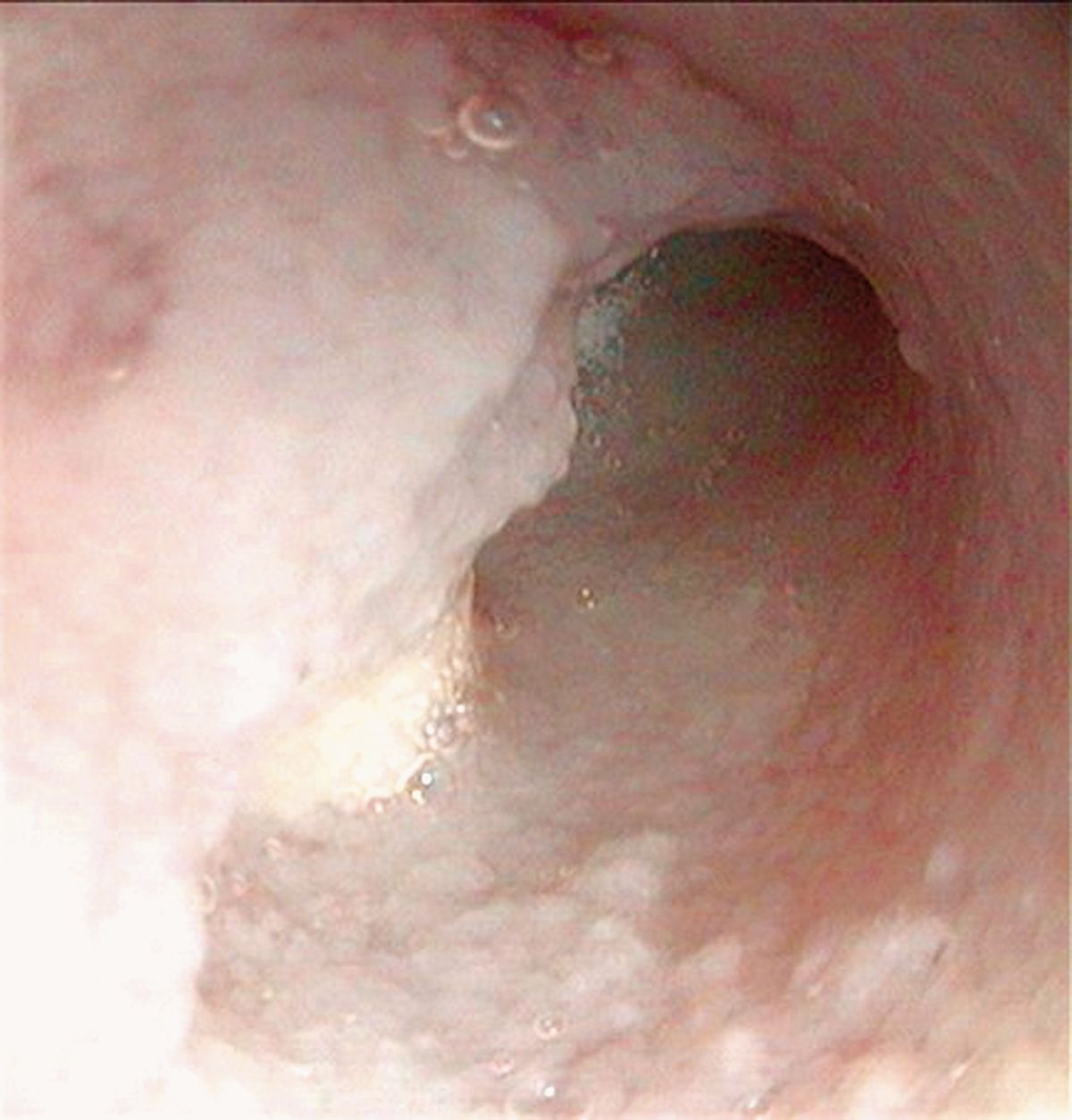 Endoscopic image of the proximal duodenum from a 12-year-old spayed domestic shorthair cat that presented for chronic vomiting and weight loss. Note the granularity of the duodenal mucosa. Histopathology was diagnostic for moderate to severe chronic lymphoplasmacytic inflammation.