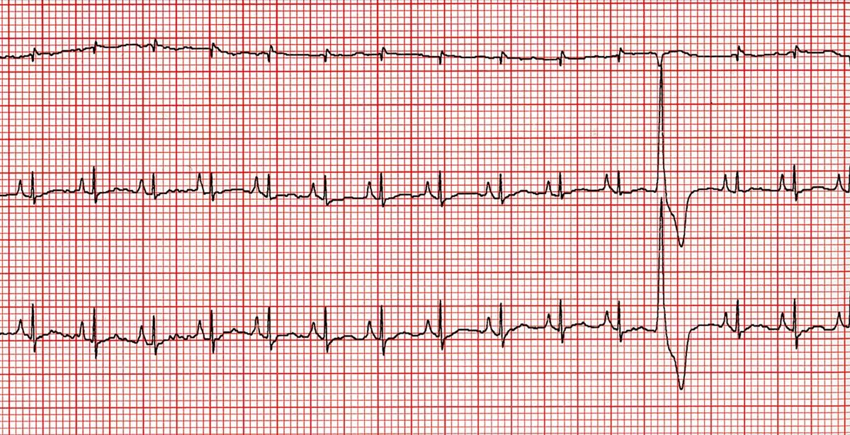 Figure 6. Tracé ECG (25 mm/sec ; 10 mm/mV) montrant les dérivations I, II et III chez un chat présentant une contraction ventriculaire prématuré. Noter le complexe QRS large et irrégulier.© Meg Sleeper
