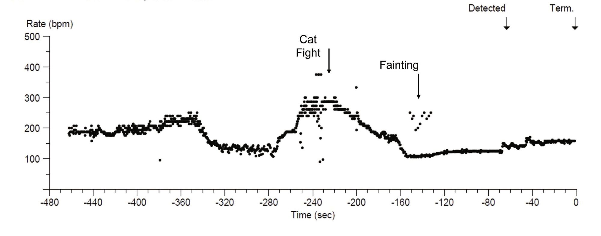 L’analyse de l’ILR après un autre épisode de syncope a montré une période de tachycardie (à 300 bpm environ) pendant une bagarre entre chats