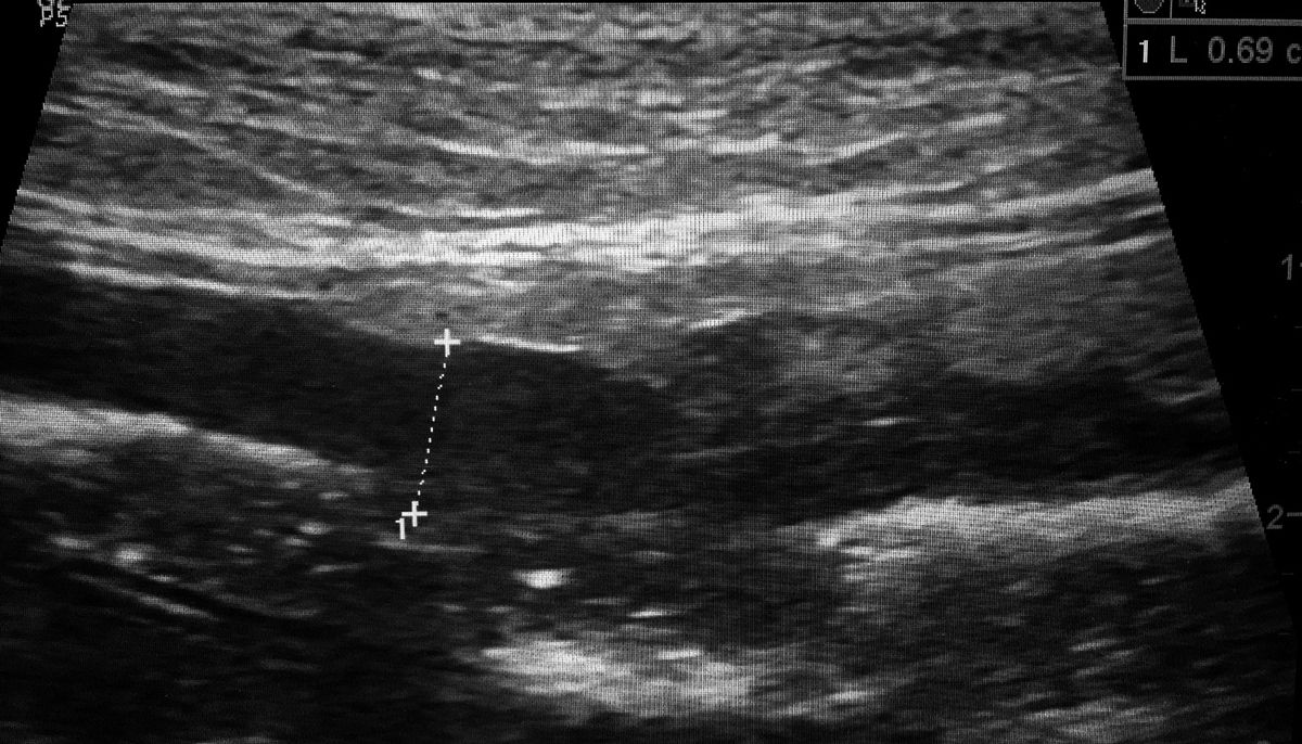 Ultrasonographic longitudinal image of a markedly thickened loop of jejunum measuring 6.9 mm in thickness (between calipers) with complete obliteration of normal architecture. This patient was diagnosed with ScLSA.