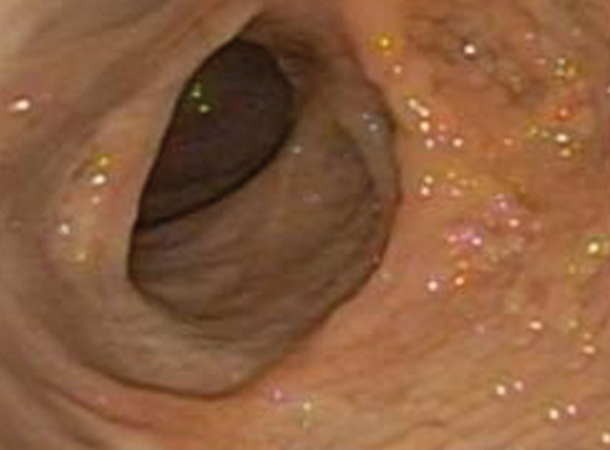 Vue endoscopique d’une oesophagite féline secondaire à une hernie hiatale.