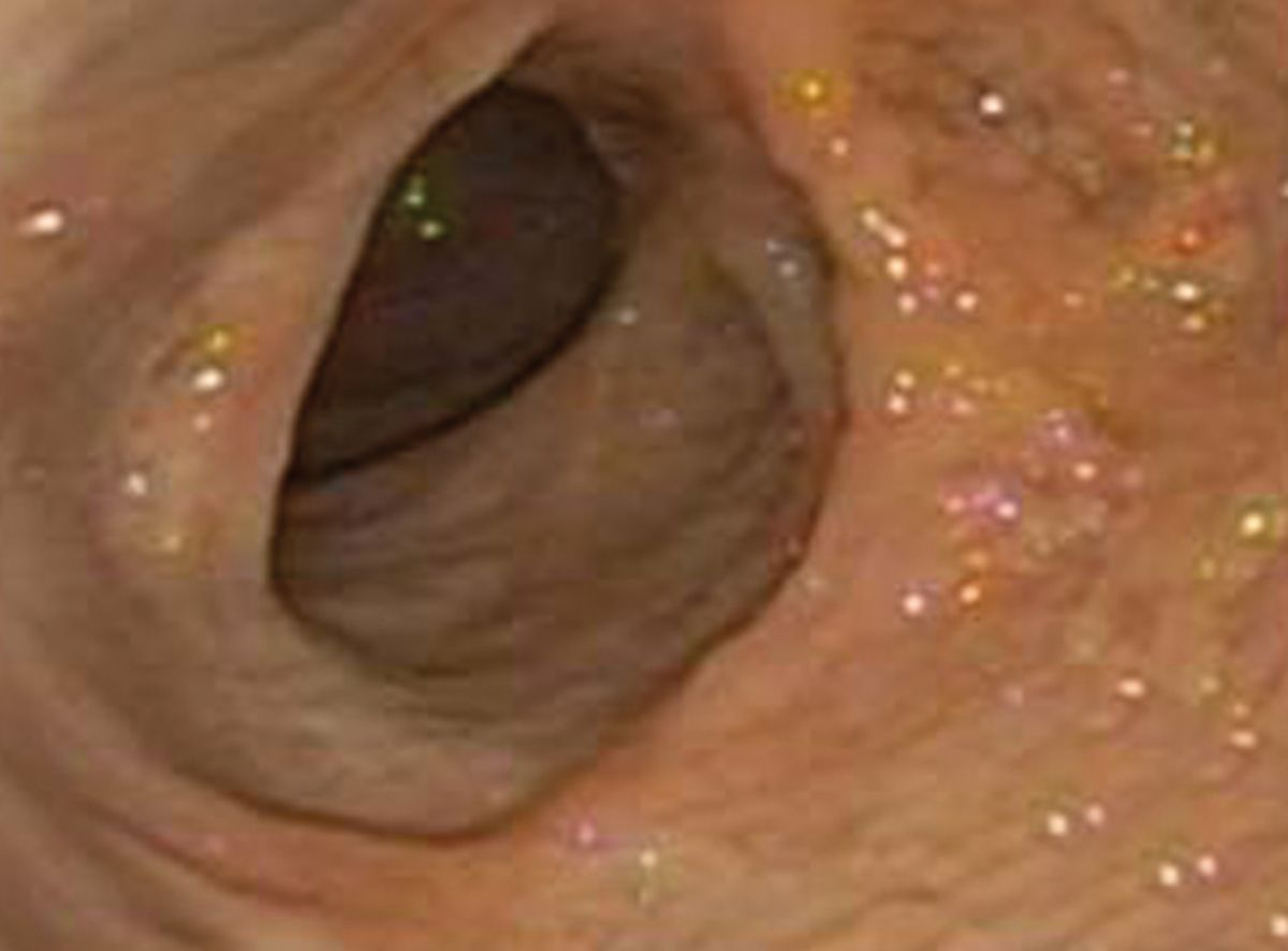 An endoscopic view of esophagitis in a cat secondary to hiatal hernia.