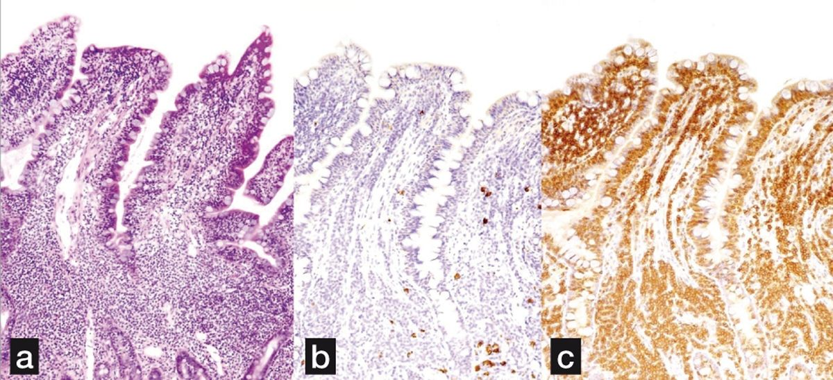 Histopathology images from the small intestine of a cat diagnosed with ScLSA. H&E staining showed a marked diffuse infiltrative pattern affecting the mucosa and villi (a); note that the staining pattern fades when immunohistochemistry against B cells is performed (b) but is positive when immunohistochemistry against T cells is performed, confirming a predominantly T cell infiltrate (c).